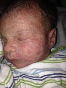 A baby with red rash on its face Description automatically generated